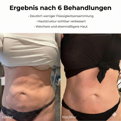 JunaVie Cellulite Behandlung
